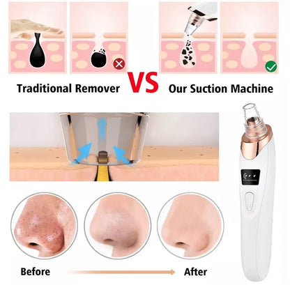 5in1 Blackhead Remover Machine Rechargeable | Face Vacuum Derma Suction With 5 Heads | Blackhead Removing Machine